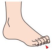 足の指のトラブル